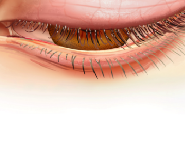 animation of illustrated demodex mites holding party favors in front of an illustrated eye