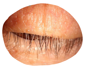 eyelid cured of demodex blepharitis db